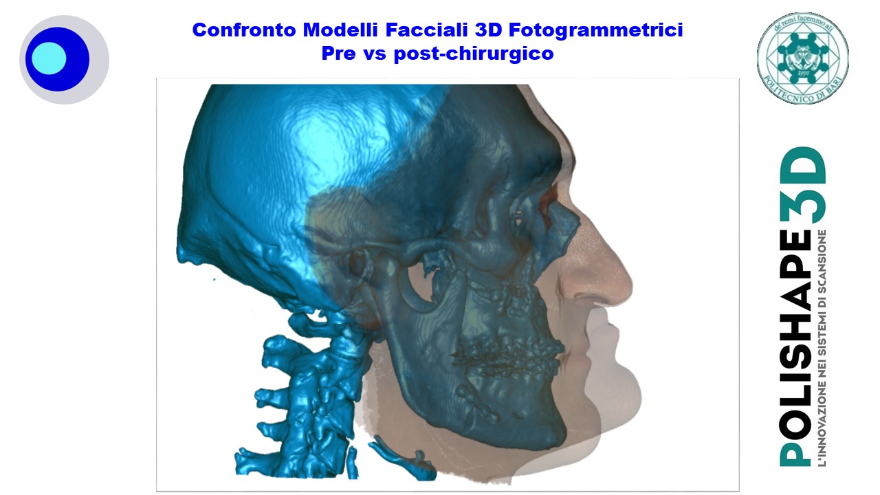 Confronto Modelli Facciali 3D Fotogrammetrici  Pre vs post-chirurgico  